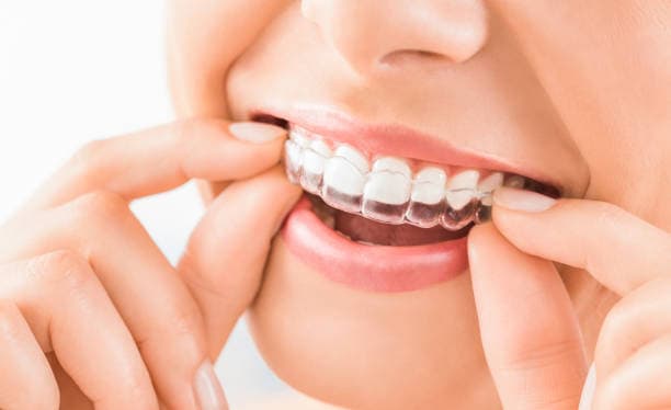Invisalign & Clear Aligners